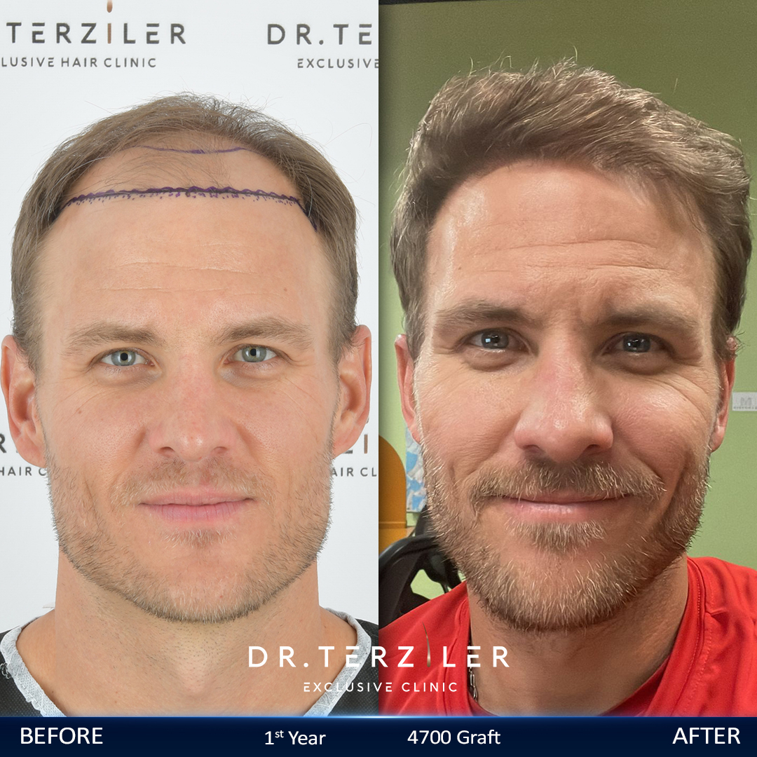 Trapianto di capelli con tecnica DHI: foto prima e dopo a 12 mesi, densit&agrave; naturale ottenuta con la penna implantatrice Choi presso la clinica del dottor Terziler