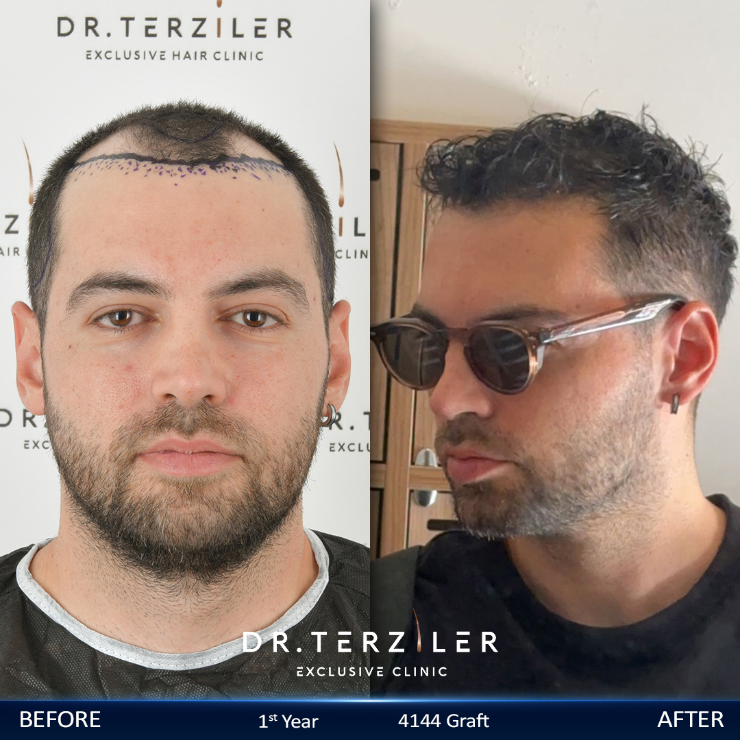 Risultati prima e dopo un trapianto di capelli con tecnica DHI in Turchia: ripristino dell'attaccatura frontale e della densit&agrave; dei capelli a cura del dott. Terziler a Istanbul