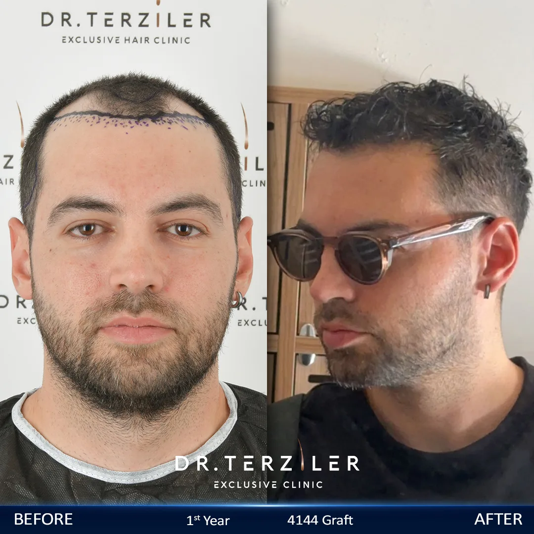 Resultados del trasplante capilar DHI &laquo;antes y despu&eacute;s&raquo; en Turqu&iacute;a: recuperaci&oacute;n de la l&iacute;nea frontal y la densidad capilar a cargo del Dr. Terziler en Estambul