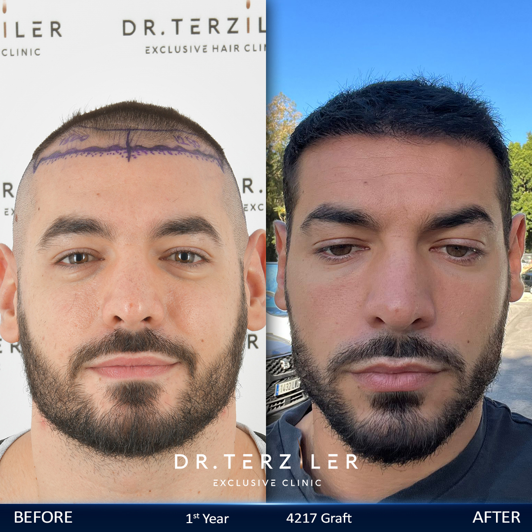 Foto &ldquo;prima e dopo&rdquo; di un paziente sottoposto a trapianto di capelli con tecnica DHI: copertura della corona e dell&rsquo;attaccatura dei capelli eseguita dal dottor Servet Terziler, chirurgo accreditato dall&rsquo;AACI