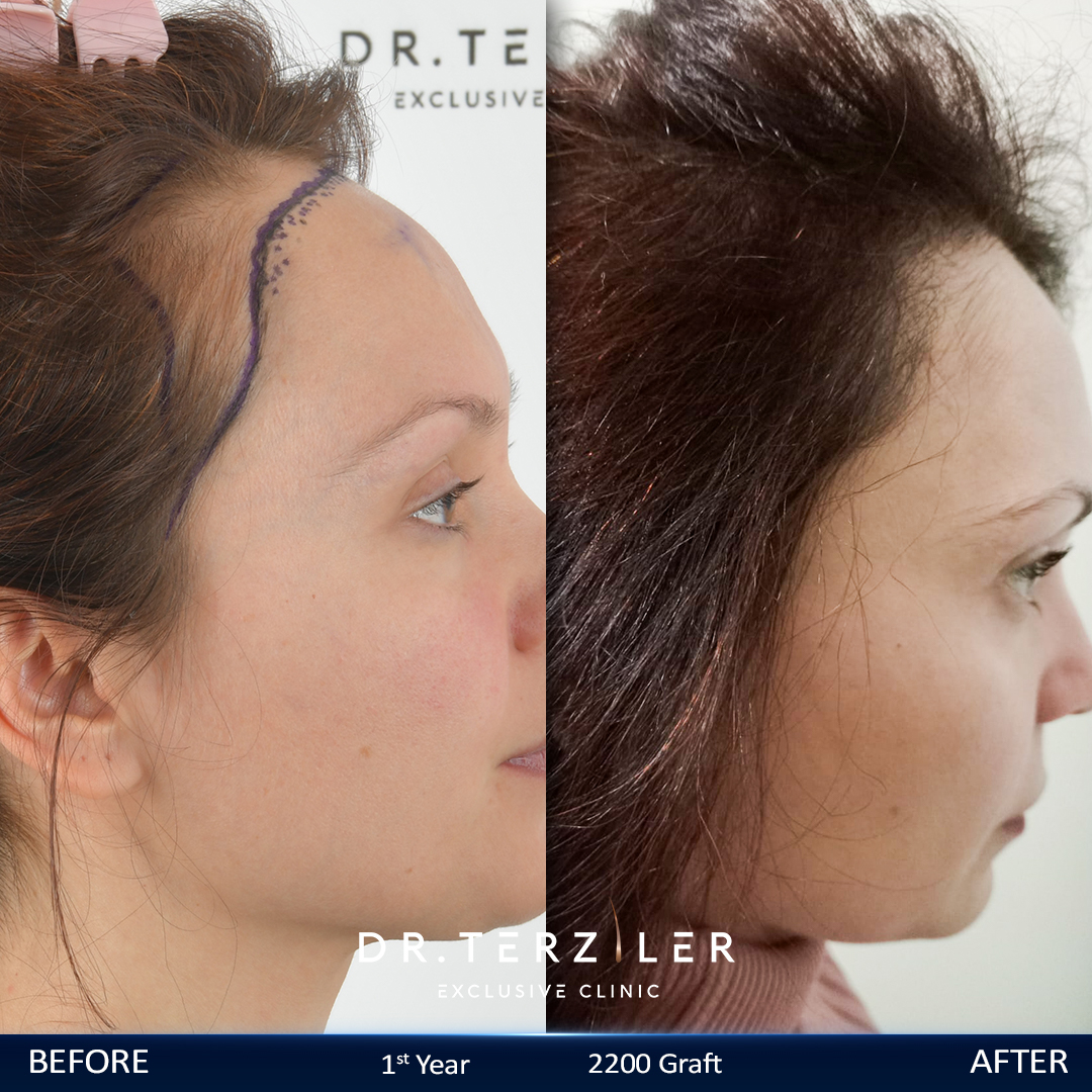 Female hair transplant in Turkey before and after showing restored hairline density for a woman patient at Dr. Terziler