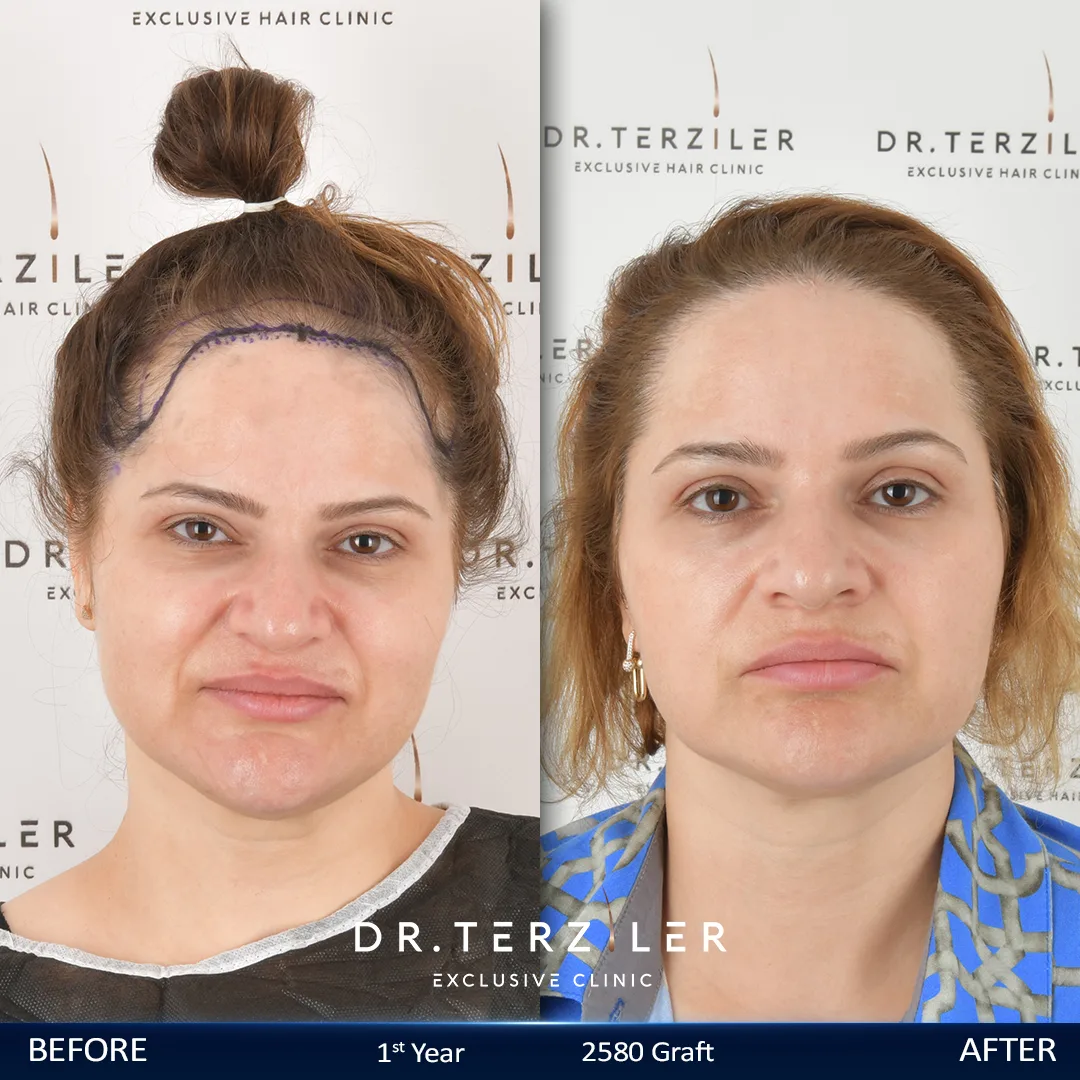 Female hair transplant Turkey before and after 4th month result, no-shave DHI for female pattern hair loss at Dr. Terziler