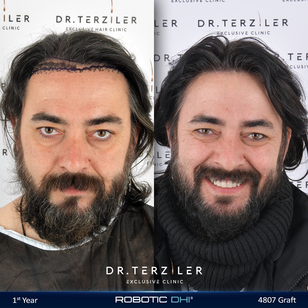 Hair Transplant Turkey Cost — USA Robotic DHI Before and After Hair transplant Turkey cost before and after, USA patient, 4,807 graft Robotic DHI result