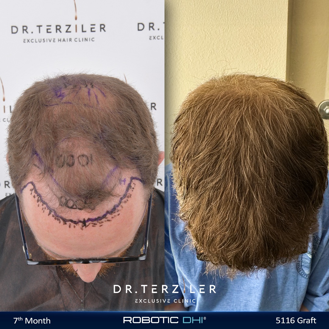 How Much Does a Hair Transplant Cost in Turkey — UK Robotic DHI Result How much does a hair transplant cost in Turkey, UK patient 5,116 graft Robotic DHI before and after