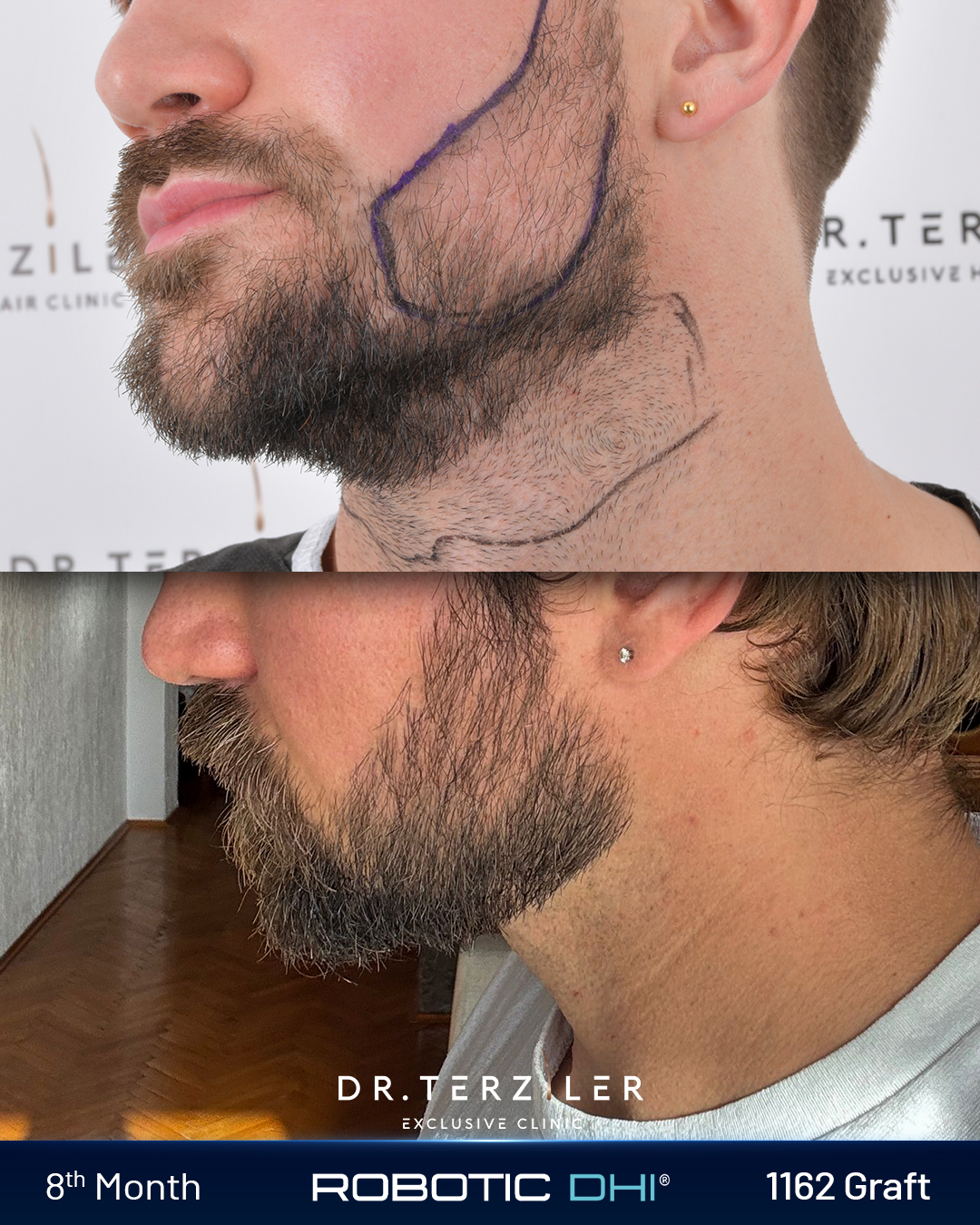 Joze beard restoration in Turkey left side profile before and after, natural beard transplant result at Dr. Terziler Exclusive Clinic