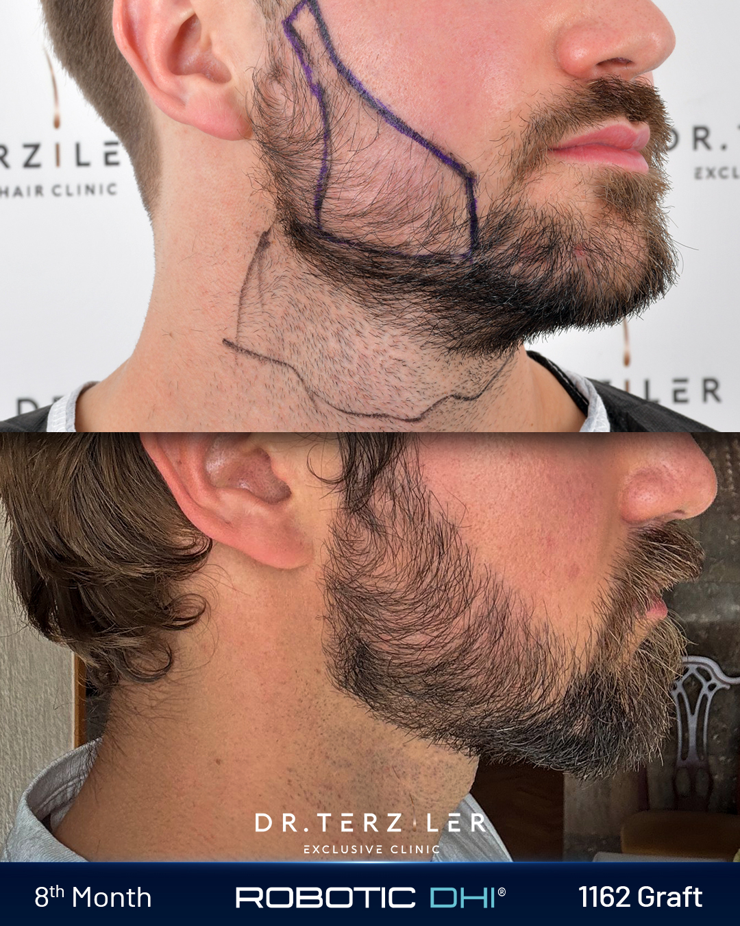 Joze beard transplant Turkey before after right side profile, dense jawline result at Dr. Terziler Exclusive Clinic