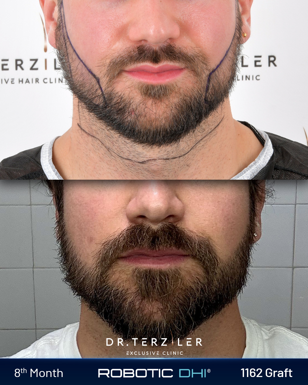 Joze beard transplant Turkey before and after front view, 1162 graft Robotic DHI facial hair restoration at Dr. Terziler Exclusive Clinic