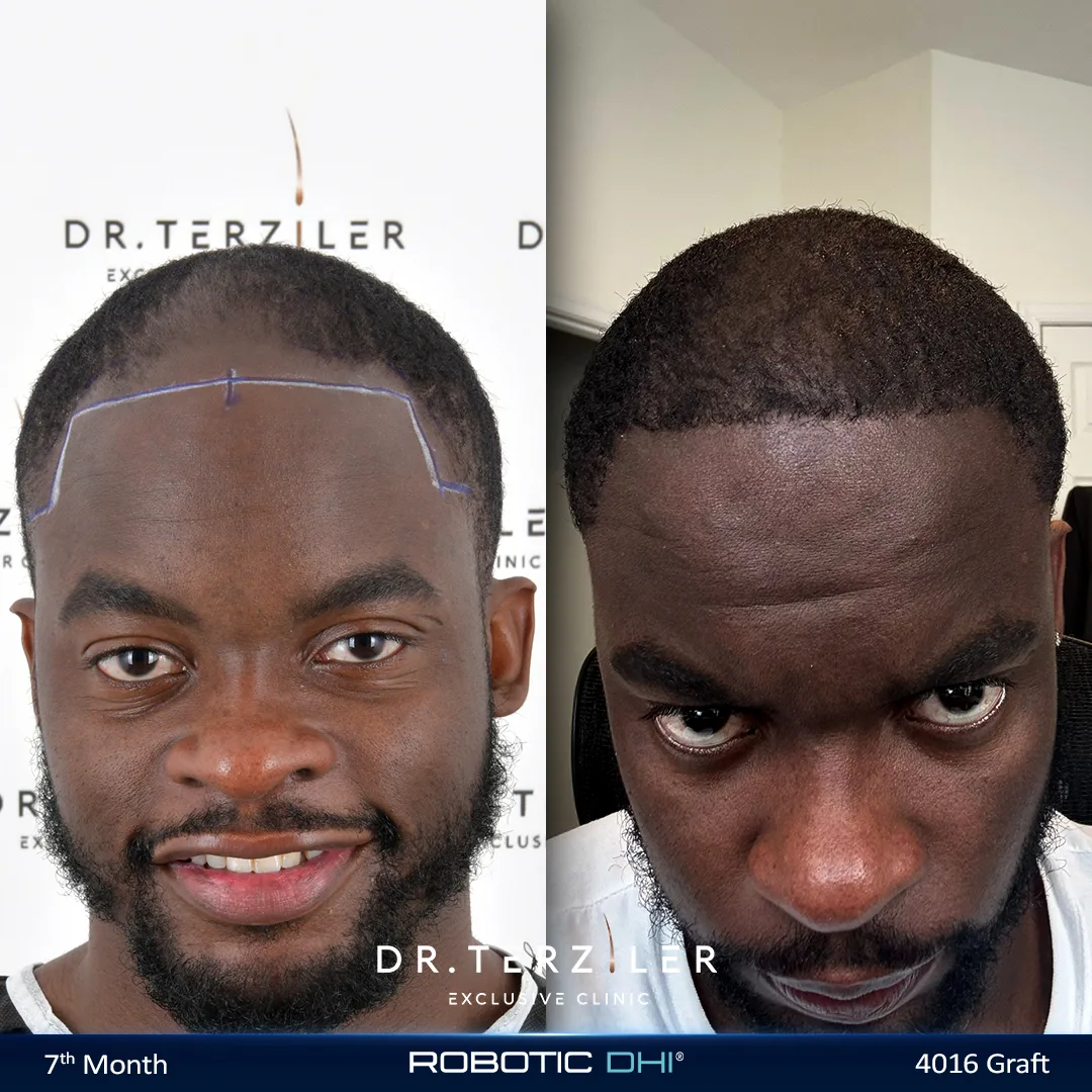 Afro Hair Transplant Cost in Turkey — USA Before and After Afro hair transplant cost in Turkey before and after, USA patient result