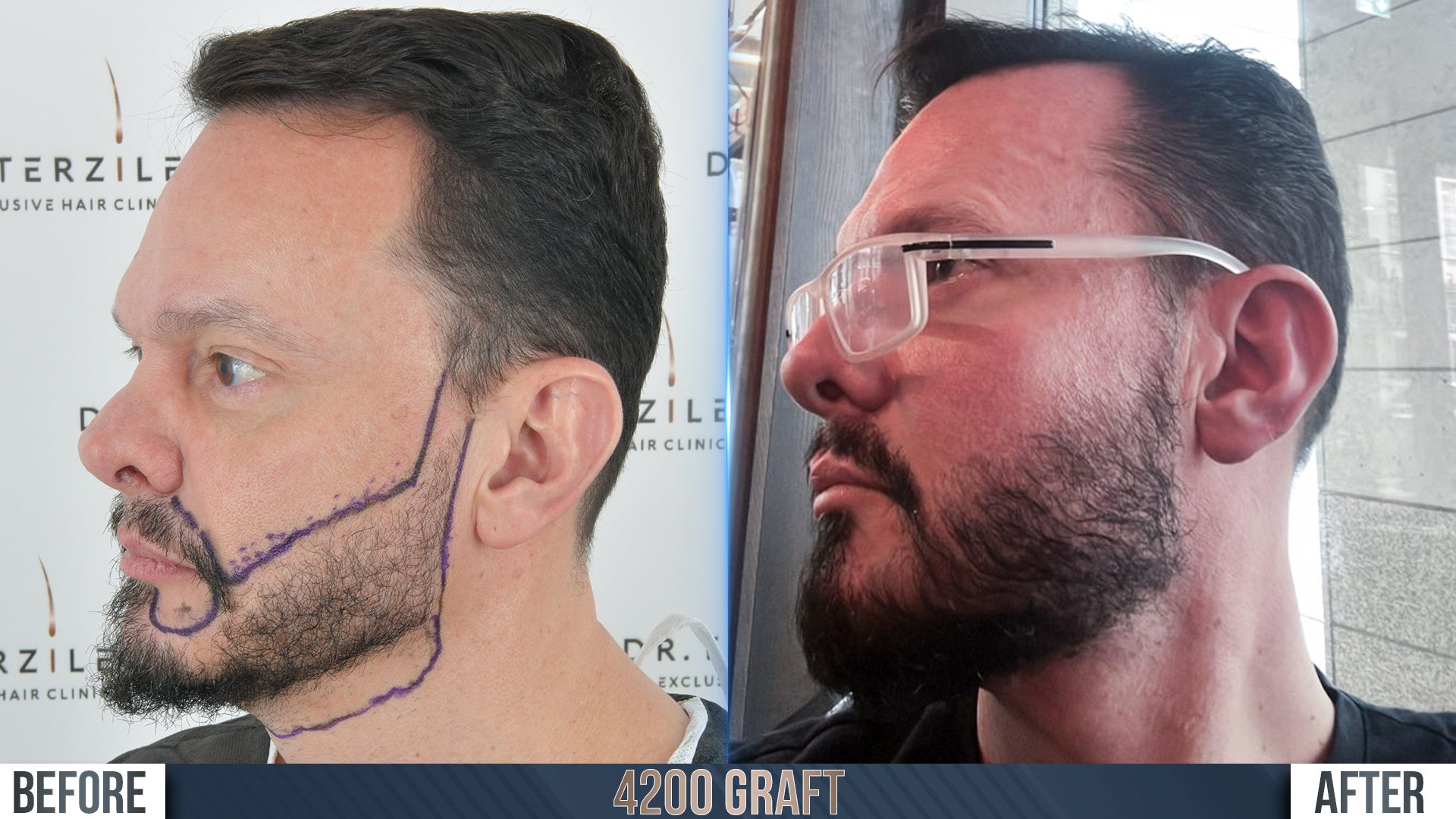 Sideburn transplant Turkey before and after, natural temporal hairline and facial framing restored with Robotic DHI at Dr. Terziler Exclusive Clinic