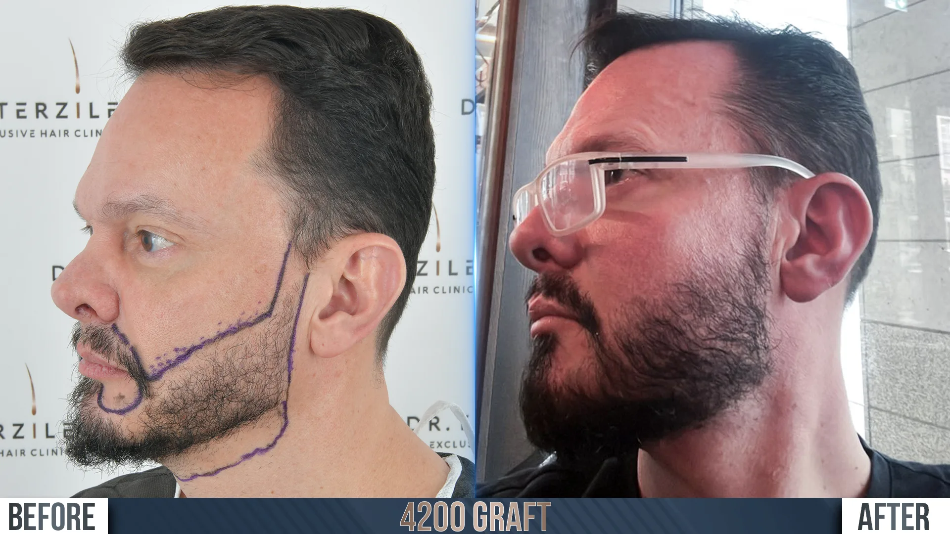 Sideburn transplant Turkey before and after, natural temporal hairline and facial framing restored with Robotic DHI at Dr. Terziler Exclusive Clinic
