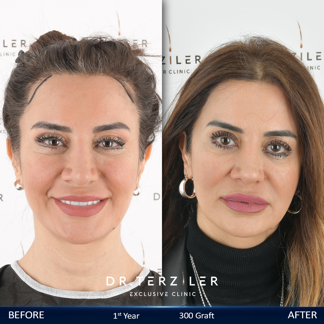 Woman hair transplant in Turkey before and after natural hairline result at Dr. Terziler Exclusive Clinic Istanbul