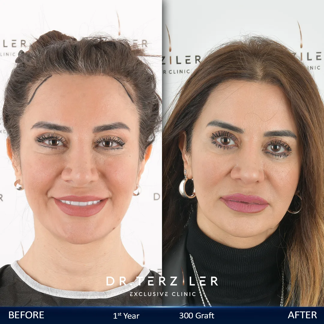 Woman hair transplant in Turkey before and after natural hairline result at Dr. Terziler Exclusive Clinic Istanbul