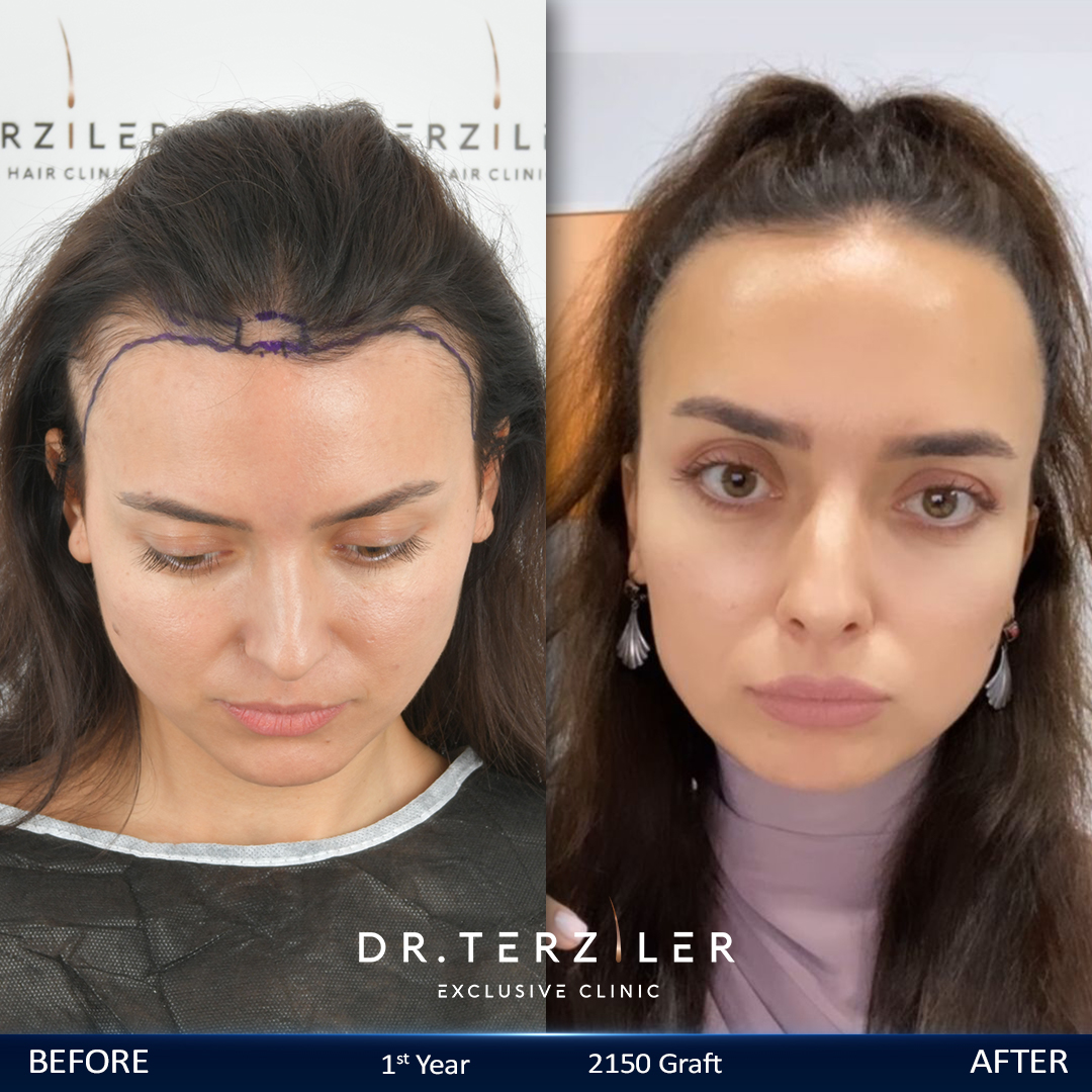 Female Hair Transplant Cost in Turkey — Before and After Female hair transplant cost in Turkey before and after, USA patient, 2,150 graft result