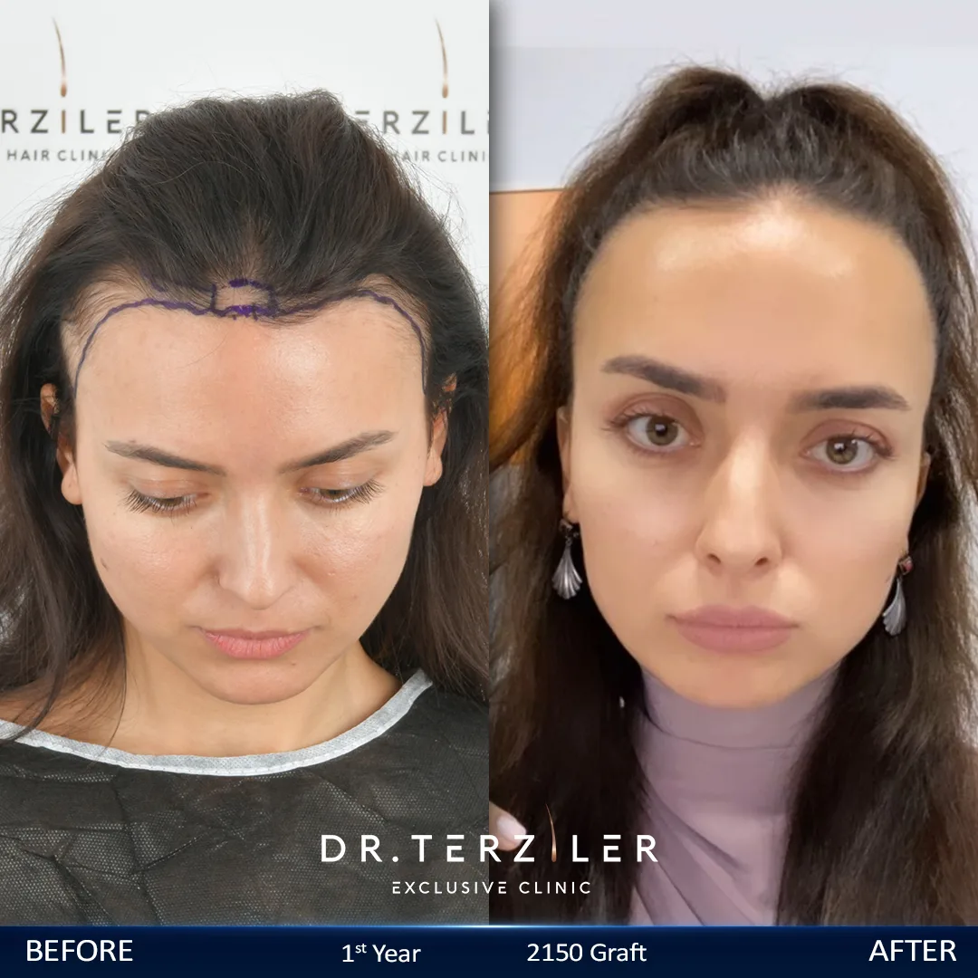 Female Hair Transplant Cost in Turkey — Before and After Female hair transplant cost in Turkey before and after, USA patient, 2,150 graft result