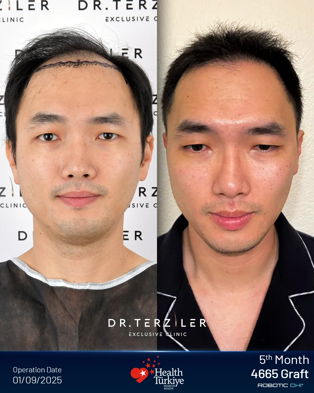 Hair transplant Turkey before and after result for Wei-Lun C., a Taiwan patient treated with DHI, 4665 grafts, 5 month result.