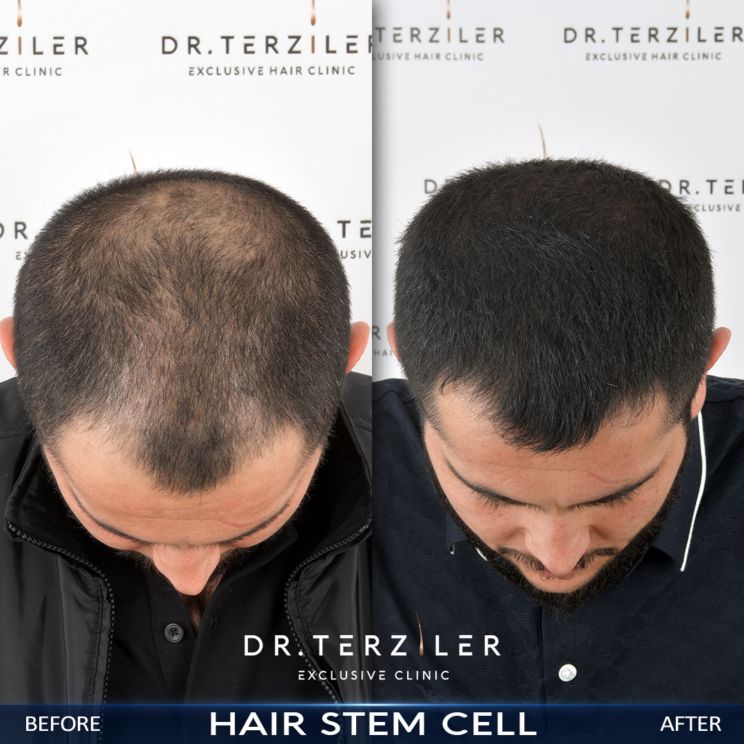 Dr. Terziler Exclusive Clinic erkek hasta k&ouml;k h&uuml;cre destekli sa&ccedil; tedavisi &ouml;ncesi ve sonrası sonucu
