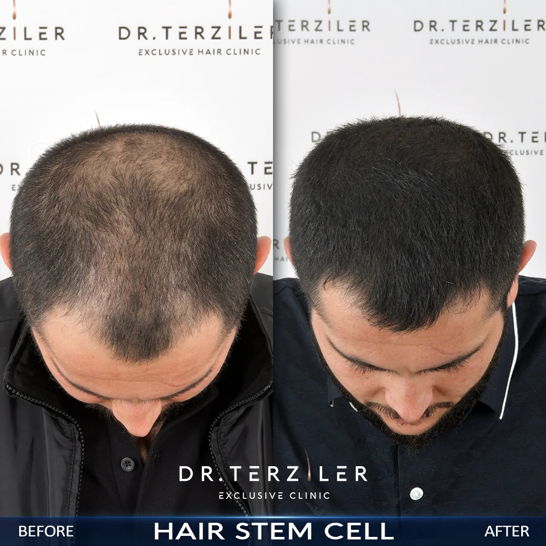 Doctor-led non-surgical hair treatments before after results in Turkey at Dr. Terziler Exclusive Clinic. Male patients shows a very good progress after hair stem cell.