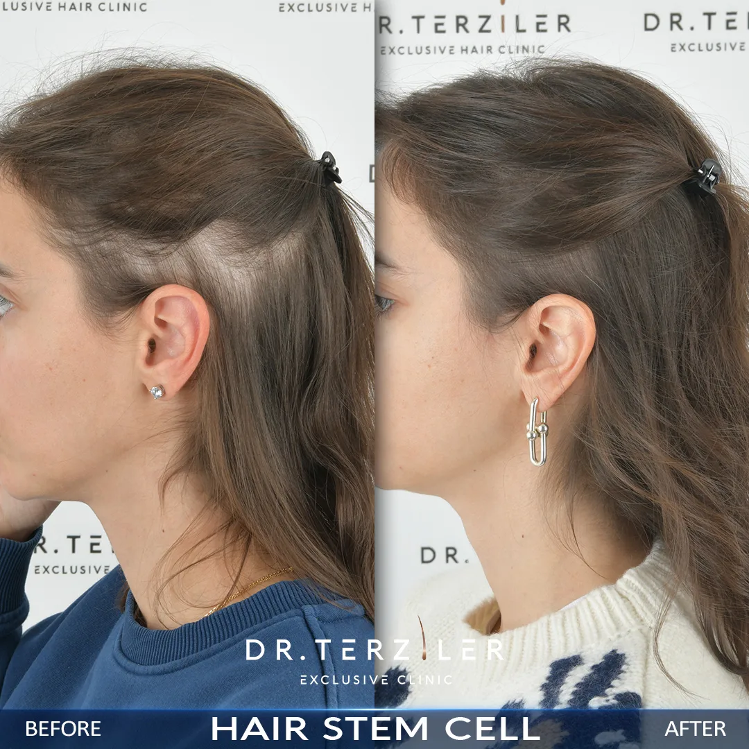 Hair treatments for thinning hair before after results by Dr. Terziler.
