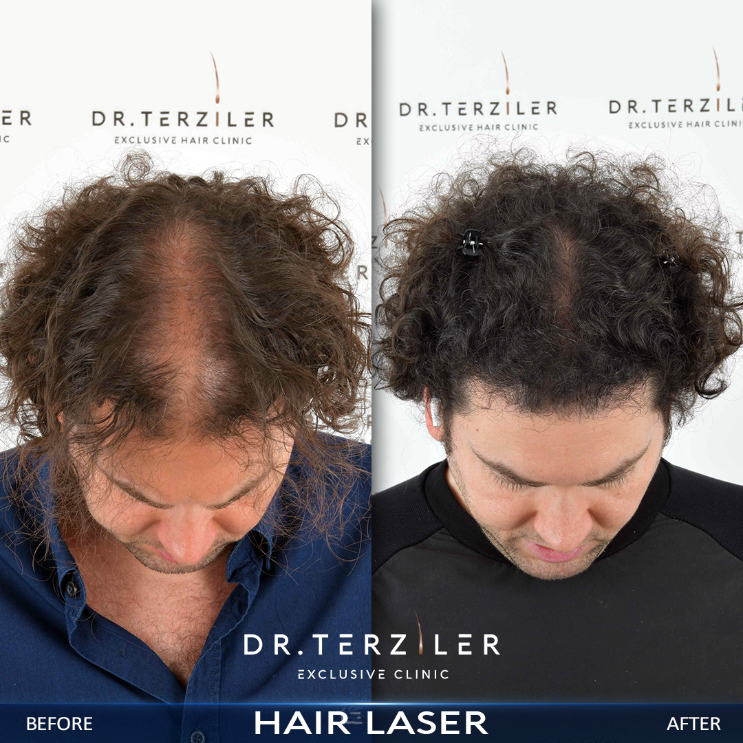 Dr. Terziler Exclusive Clinic kıvırcık sa&ccedil; lazer tedavisi &ouml;ncesi ve sonrası sonucu