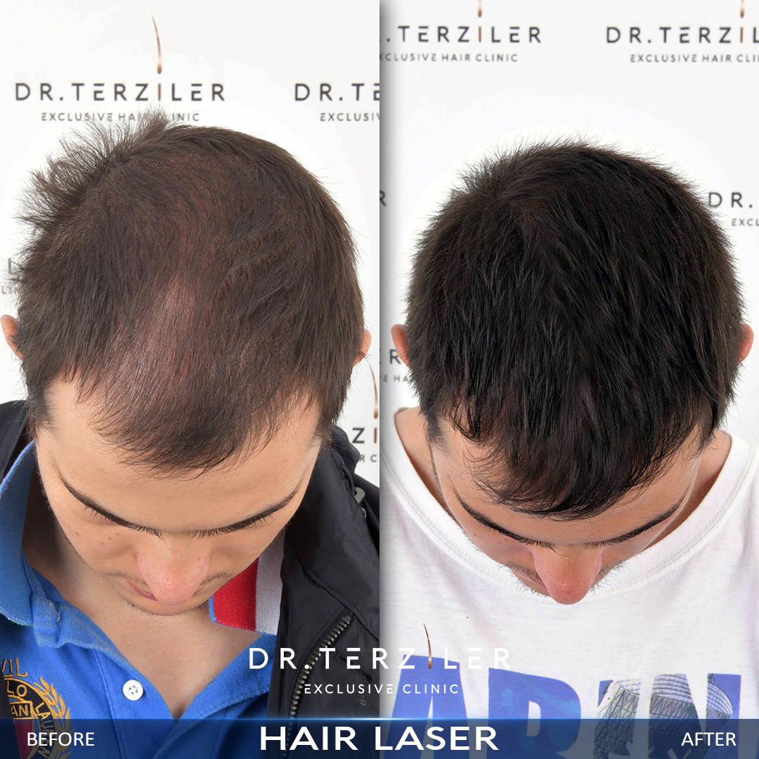 Dr. Terziler Exclusive Clinic ameliyatsız sa&ccedil; tedavisi &ouml;ncesi ve sonrası sonucu