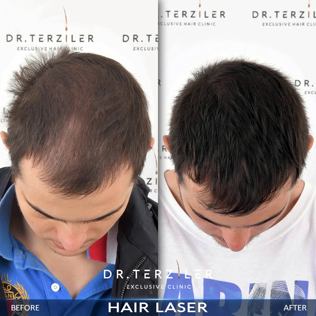 non-surgical hair growth therapy results by Dr. Terziler Exclusive Clinic