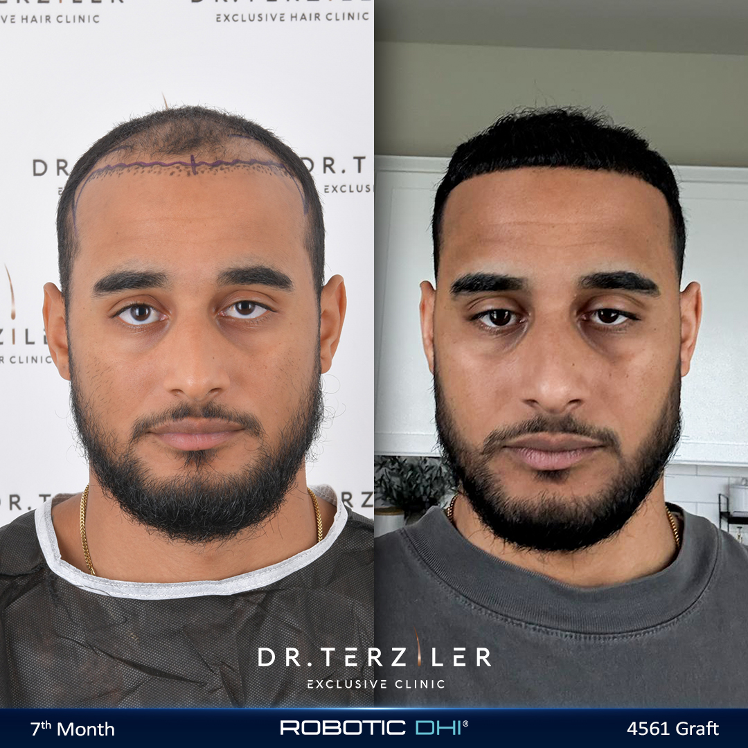 Afro hair transplant Turkey before and after,Baez from the USA, Robotic DHI, 3,610 grafts, Norwood 4 curly-hair case study at Dr. Terziler Exclusive Clinic