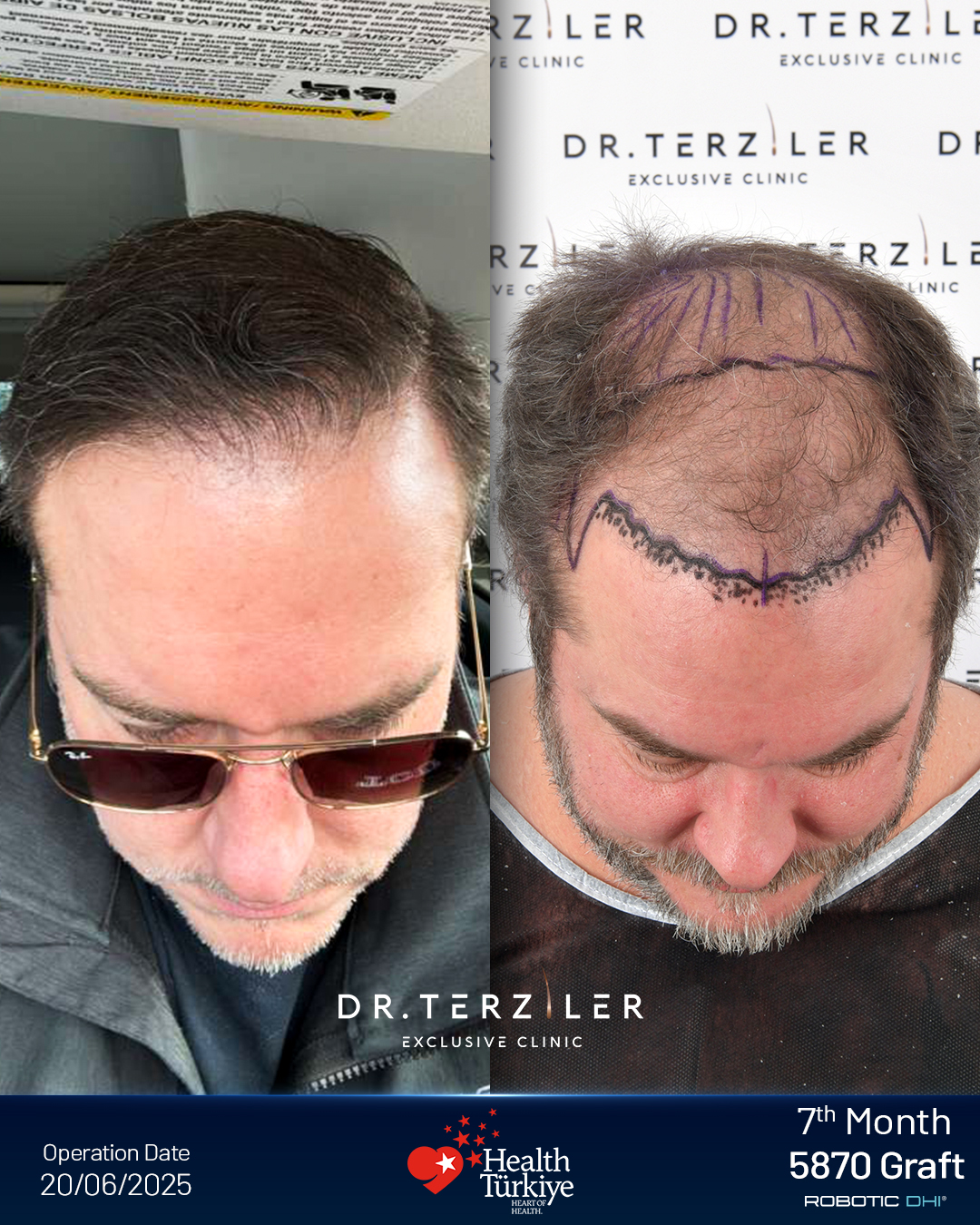 Hair transplant Turkey before and after result,Bobby T. from the UK, Robotic DHI, 5,426 grafts, Norwood 5 case study at Dr. Terziler Exclusive Clinic