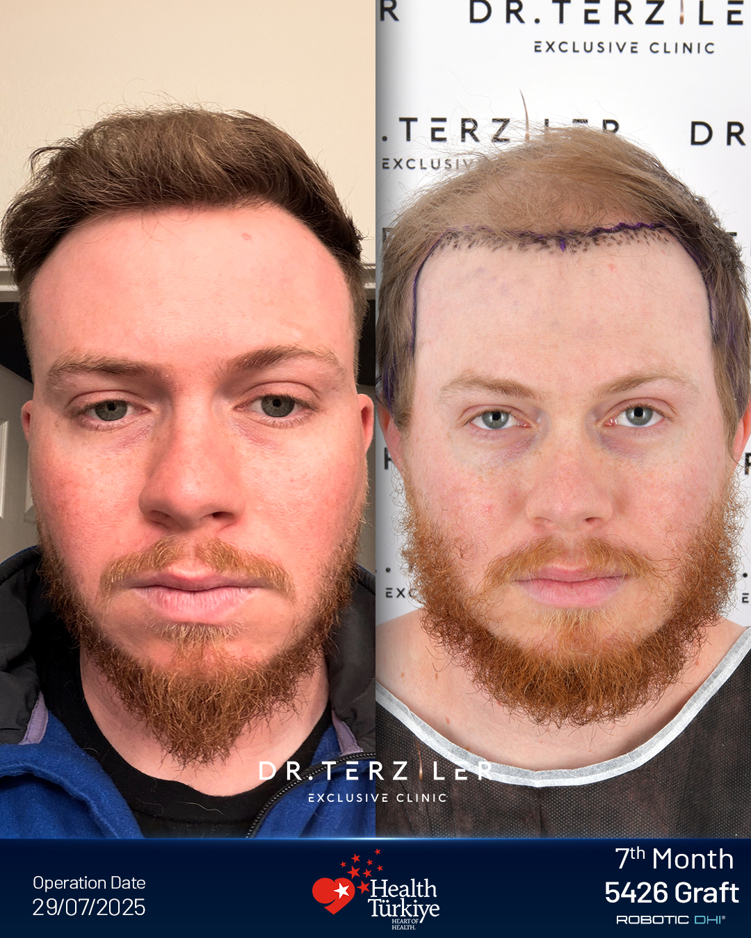 Hair transplant Turkey before and after result,Conor H. from Ireland, Robotic DHI, 5,870 grafts, Norwood 6 case study at Dr. Terziler Exclusive Clinic