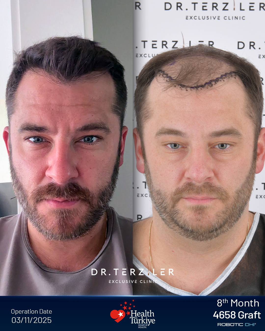 Hair transplant Turkey before and after result,Corey J. from the USA, Robotic DHI, 4,658 grafts, Norwood 4 case study at Dr. Terziler Exclusive Clinic