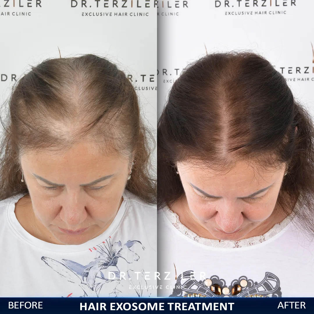 Women's exosome hair loss treatment before and after result at Dr. Terziler Exclusive Clinic — reduced shedding and a fuller hairline