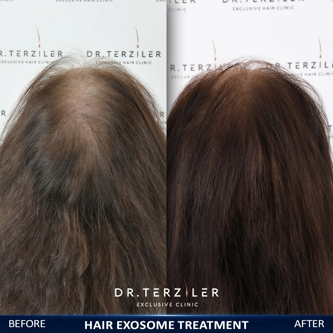 Exosome therapy for female hair thinning before and after at Dr. Terziler Exclusive Clinic, Istanbul — improved density across the top of the scalp