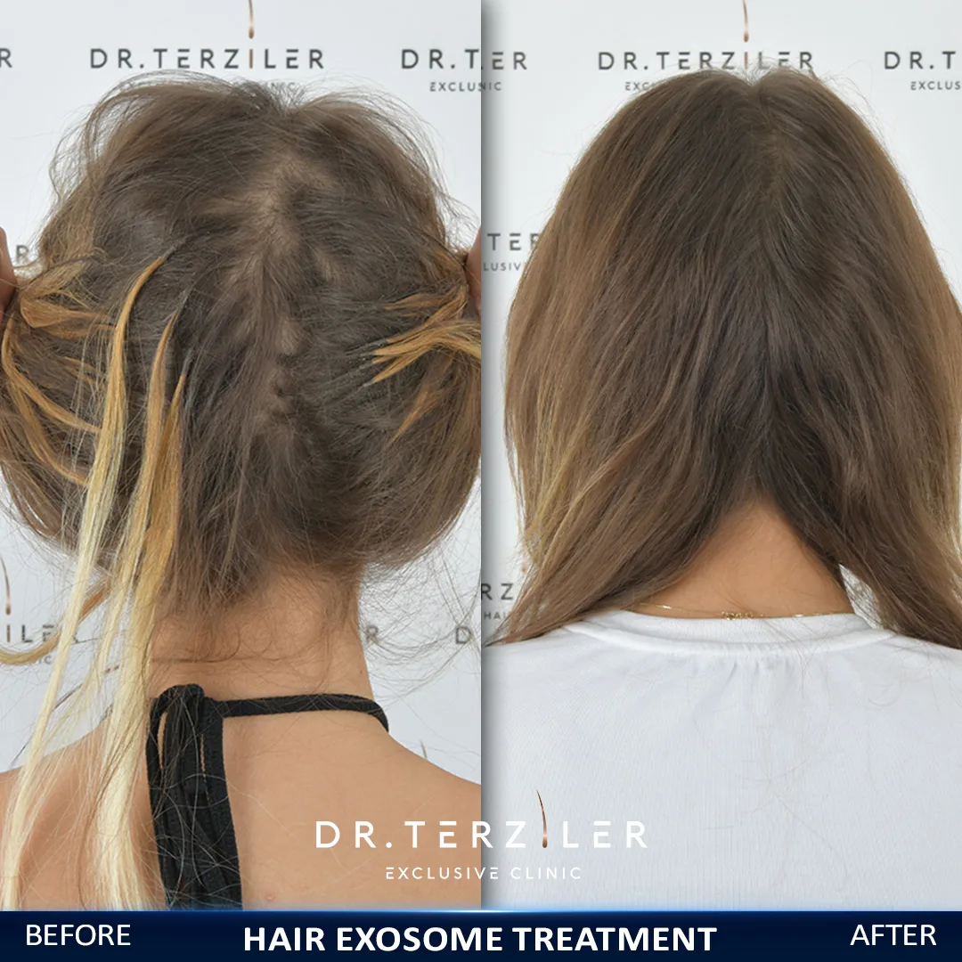Exosome treatment for women's hair loss before and after, rear view of thinning crown filling in at Dr. Terziler Exclusive Clinic, Istanbul