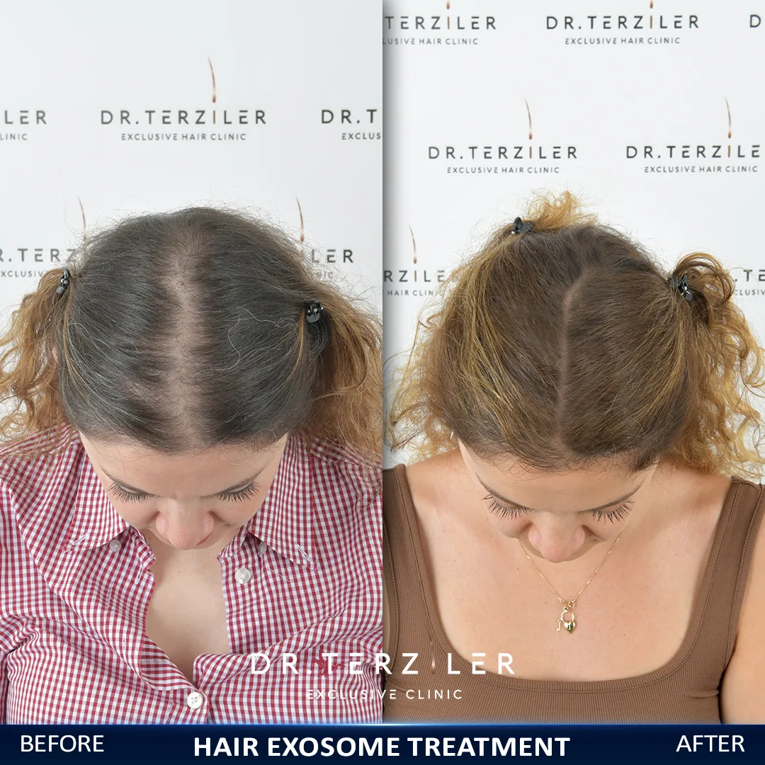 Female exosome hair therapy before and after, top-down view of a widening part becoming denser at Dr. Terziler Exclusive Clinic, Turkey