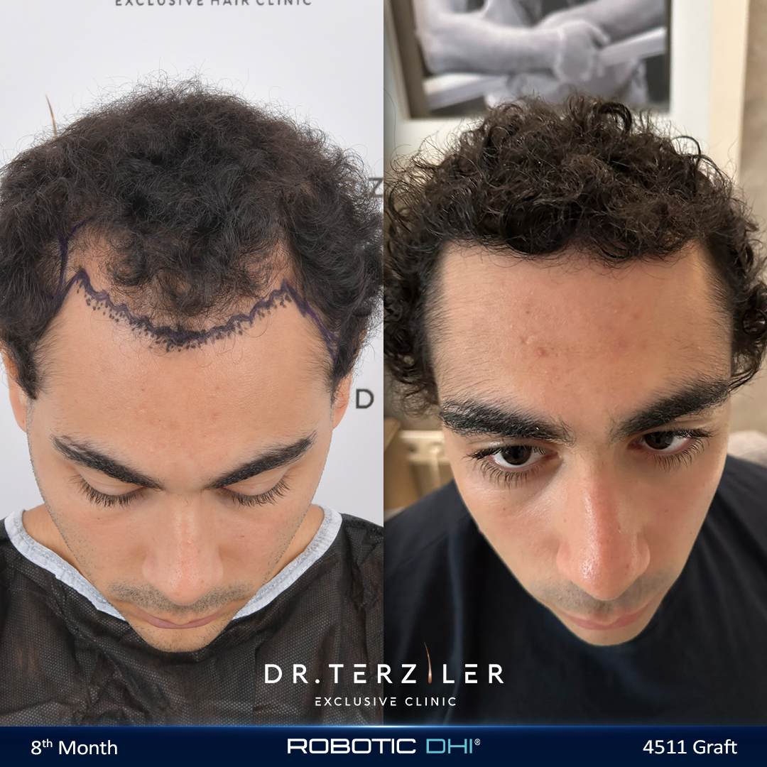 Young man hair transplant before and after in his 20s at Dr. Terziler Exclusive Clinic Istanbul, dense natural result planned around future hair loss