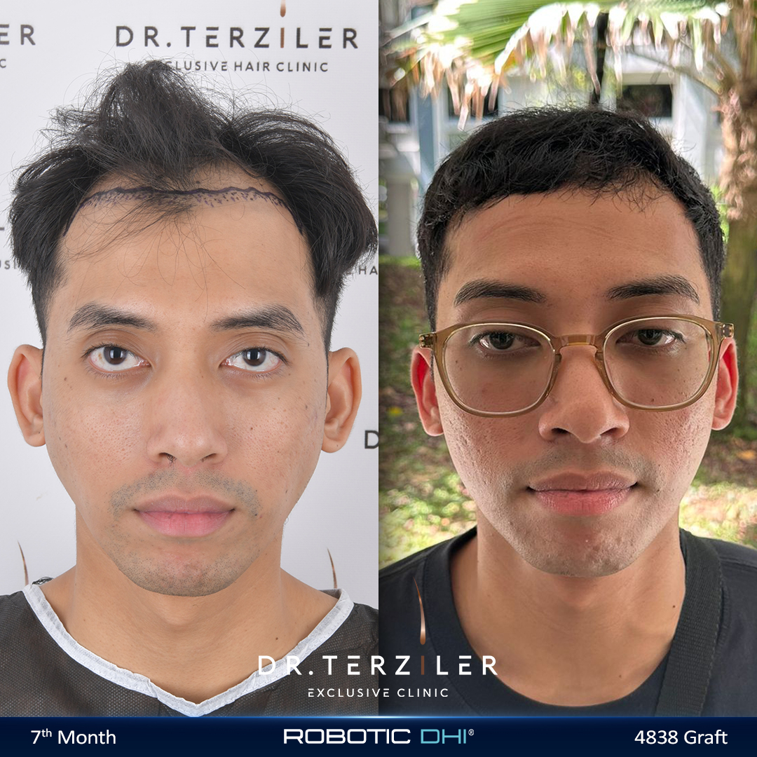 Hair transplant at 25 before and after, natural restored hairline for a young male patient, showing a good age for a hair transplant once loss is stable, Dr. Terziler Exclusive Clinic