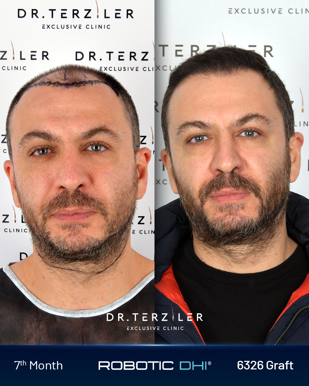 Hair transplant Turkey before and after result,Salih A. from Turkey, Robotic DHI, 6,326 grafts, Norwood 5 high-graft case study at Dr. Terziler Exclusive Clinic