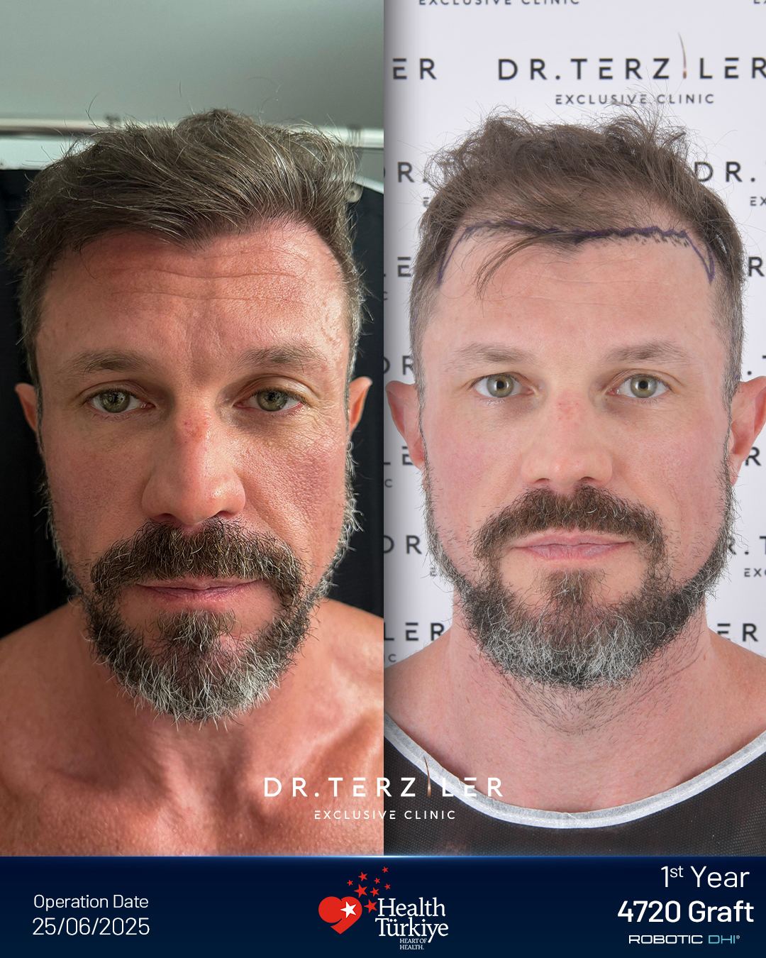 Hair transplant Turkey before and after result,Sean Joseph from the USA, Robotic DHI, 4,720 grafts, Norwood 5 case study at Dr. Terziler Exclusive Clinic