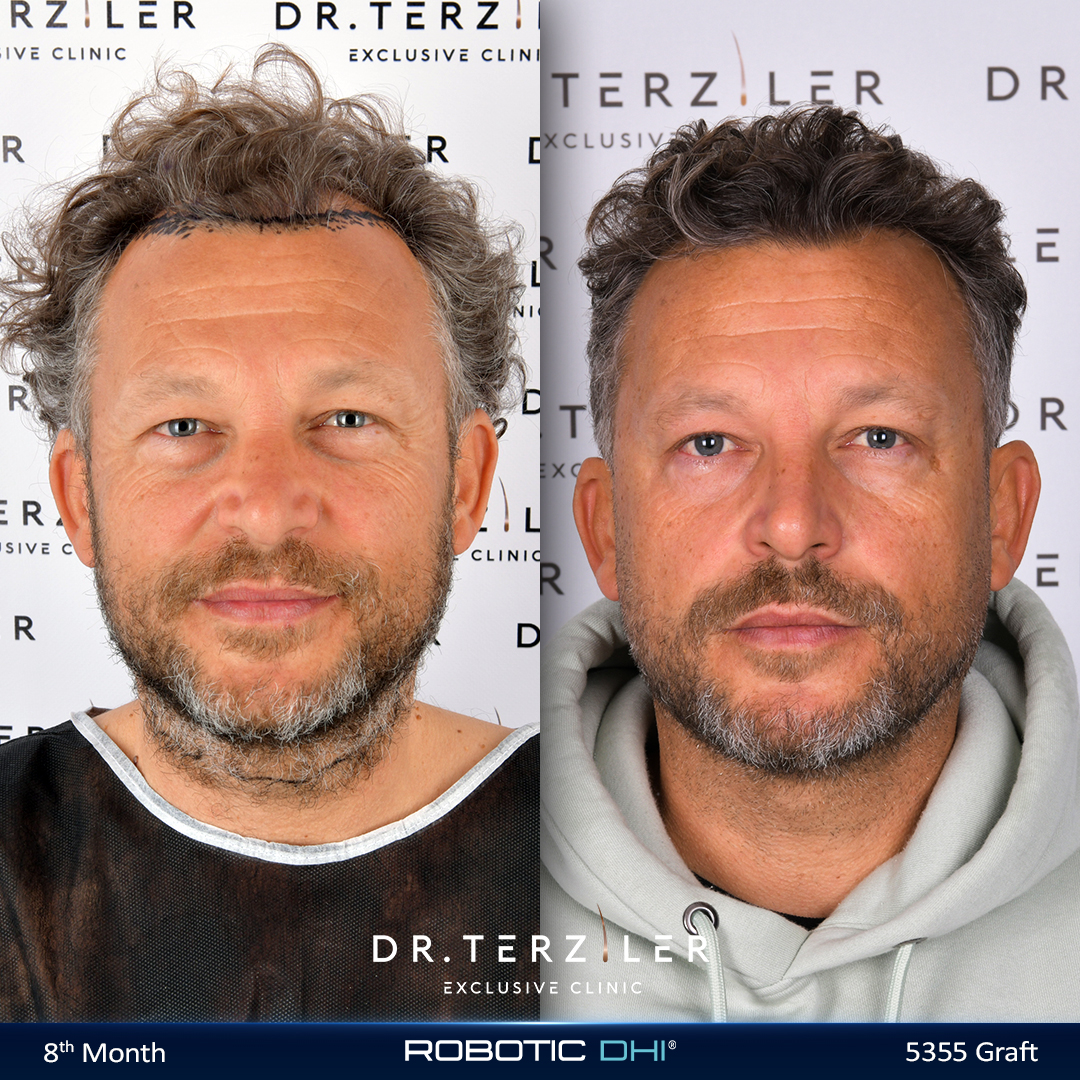 Hair transplant Turkey before and after result,Sezer D. from Turkey, Robotic DHI, 4,658 grafts, Norwood 4 case study at Dr. Terziler Exclusive Clinic