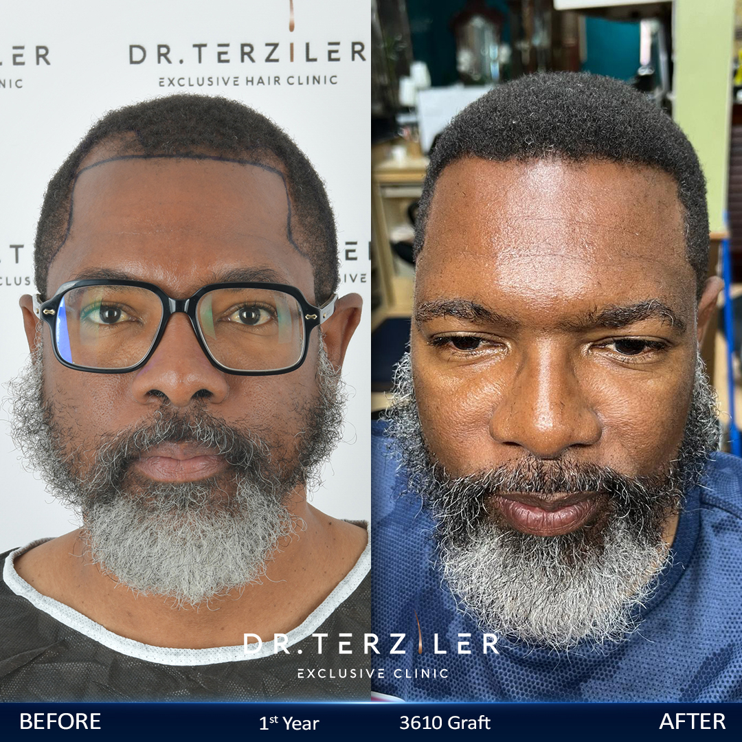 Afro hair transplant Turkey before and after,UK patient, Robotic DHI, 4,561 grafts, Norwood 4 curly-hair restoration case study at Dr. Terziler Exclusive Clinic