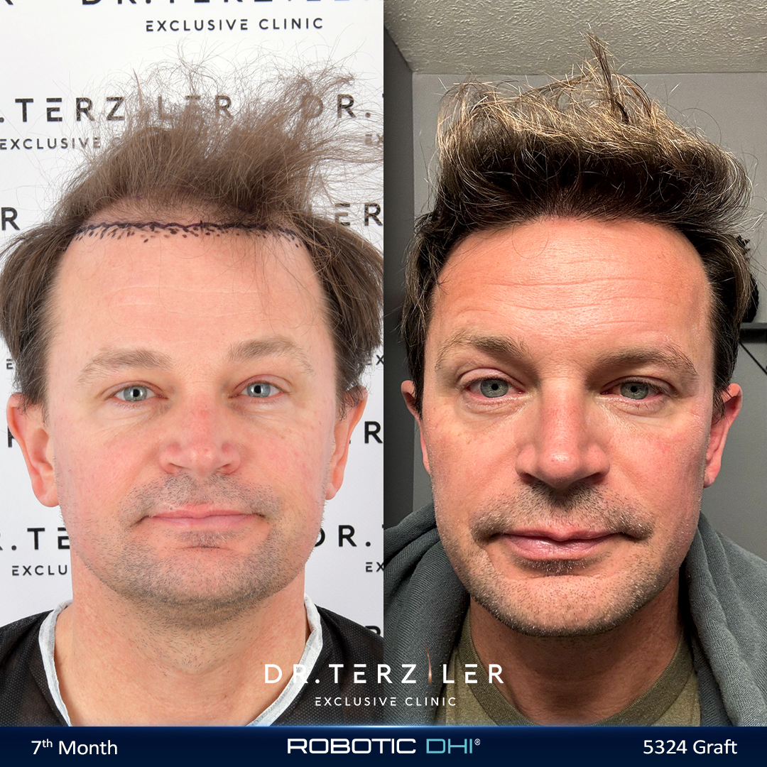 Hair transplant Turkey before and after case study,Blake D. from the USA, Picasso Robotic DHI, 5,324 grafts, Norwood 5 result at Dr. Terziler Exclusive Clinic