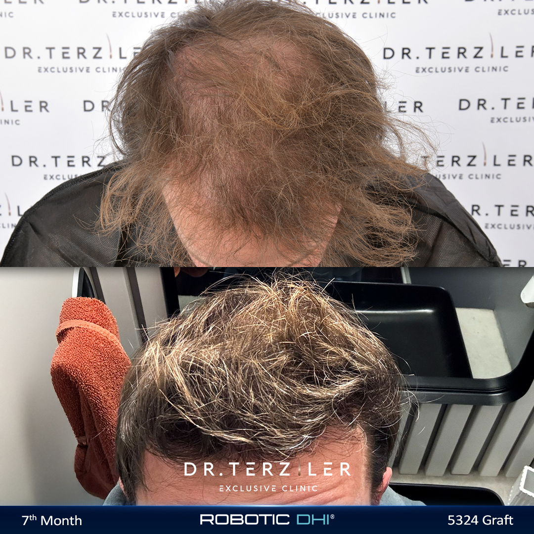 Blake's 12-month hair transplant result, top-down before and after comparison after 5,324-graft Picasso Robotic DHI at Dr. Terziler Exclusive Clinic, Turkey