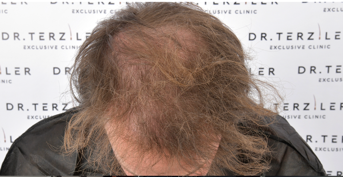Blake's hair loss before his hair transplant, top-down view of a Norwood 5 receding hairline and thinning crown before Picasso Robotic DHI at Dr. Terziler Exclusive Clinic in Turkey