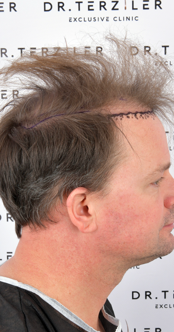 Side profile of Blake's hairline before his hair transplant Turkey, showing frontal recession before Picasso Robotic DHI, USA patient at Dr. Terziler Exclusive Clinic