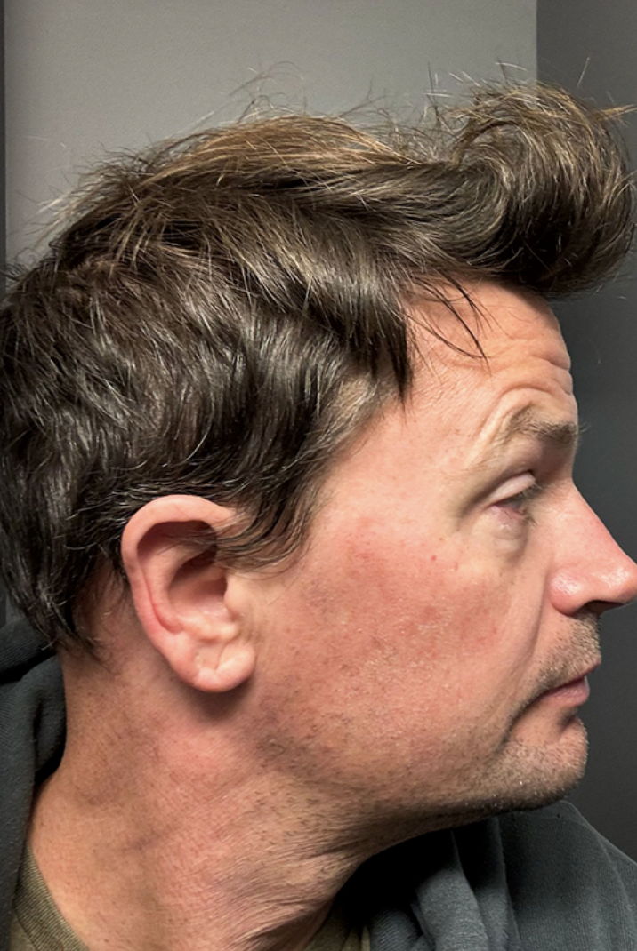 Side view of Blake's 12-month hair transplant result showing a natural restored hairline after doctor-led Picasso Robotic DHI in Turkey, USA patient at Dr. Terziler Exclusive Clinic