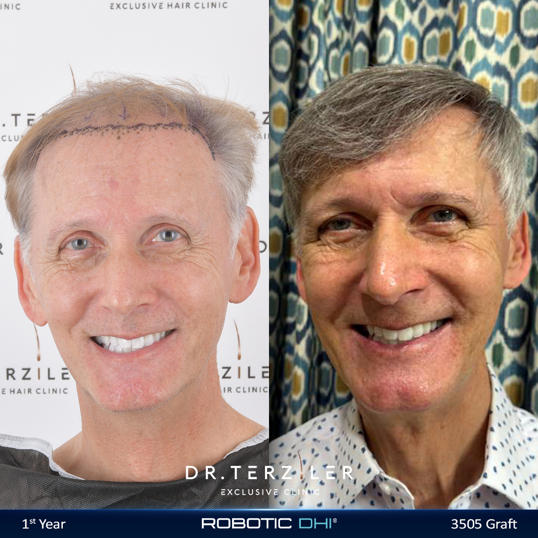 Is it too late for a hair transplant, older patient before and after showing a successful restoration later in life at Dr. Terziler Exclusive Clinic