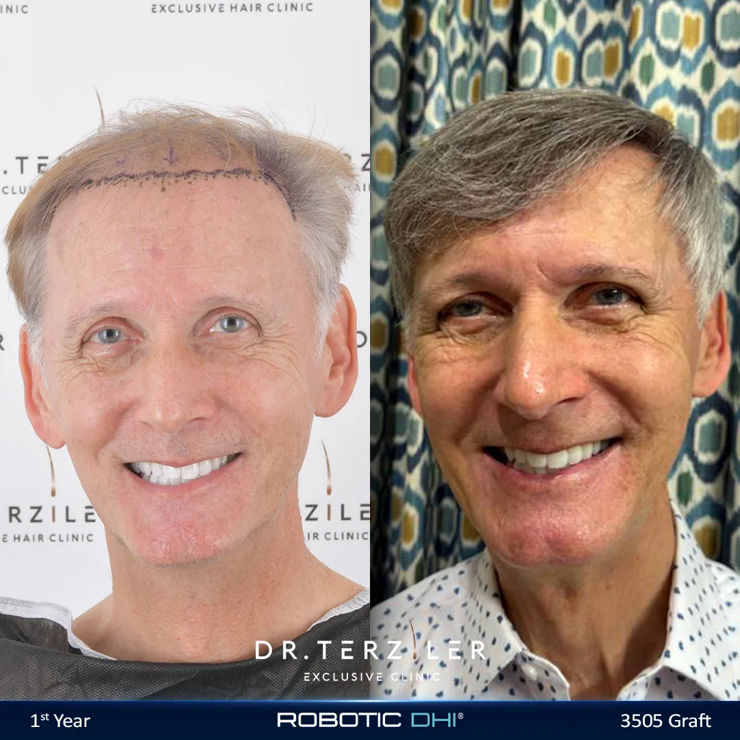 Is it too late for a hair transplant, older patient before and after showing a successful restoration later in life at Dr. Terziler Exclusive Clinic