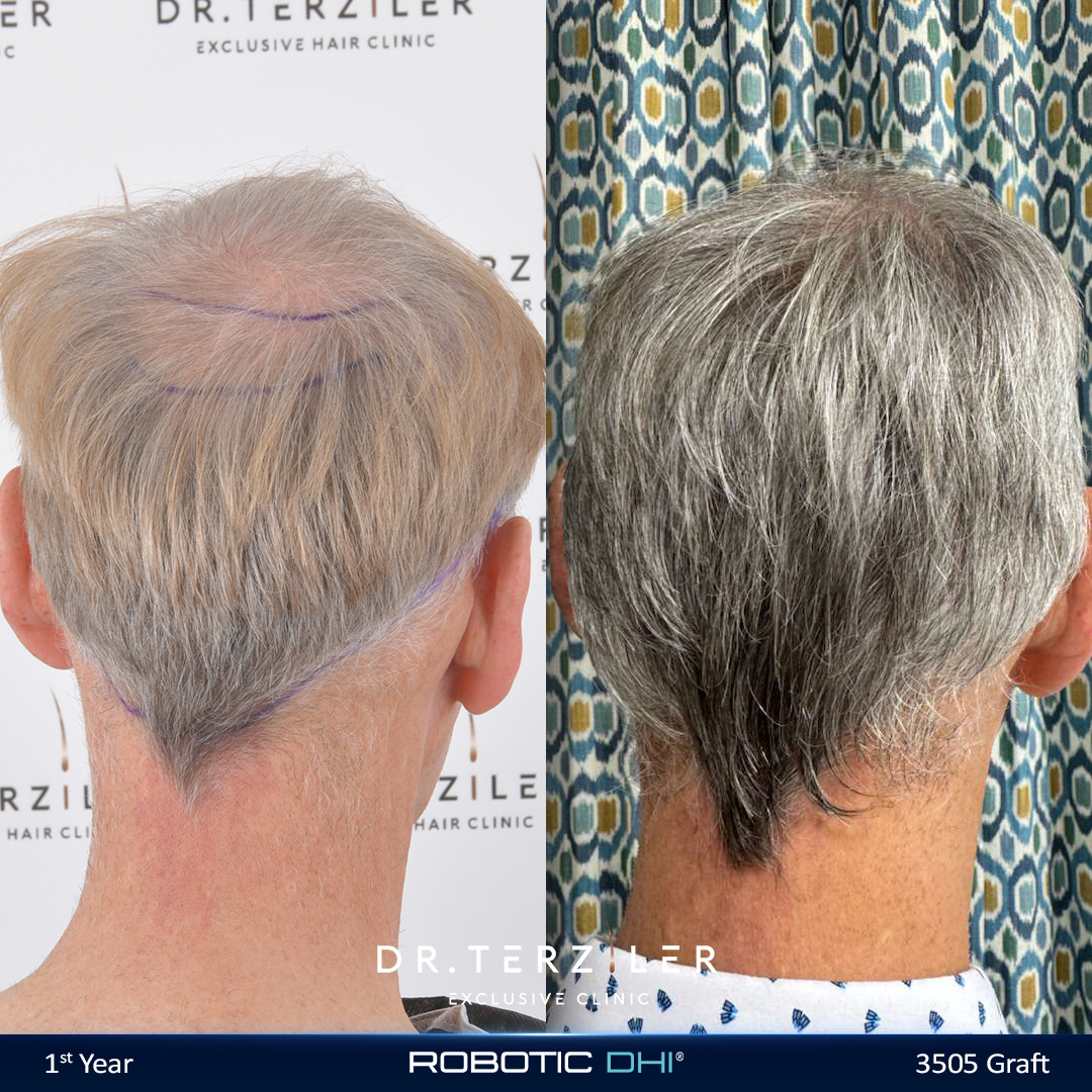 Hair transplant age limit myth, older male patient before and after with restored crown and hairline at Dr. Terziler Exclusive Clinic Turkey