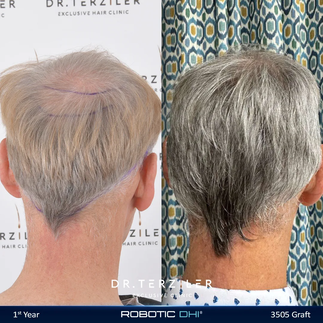 Hair transplant age limit myth, older male patient before and after with restored crown and hairline at Dr. Terziler Exclusive Clinic Turkey
