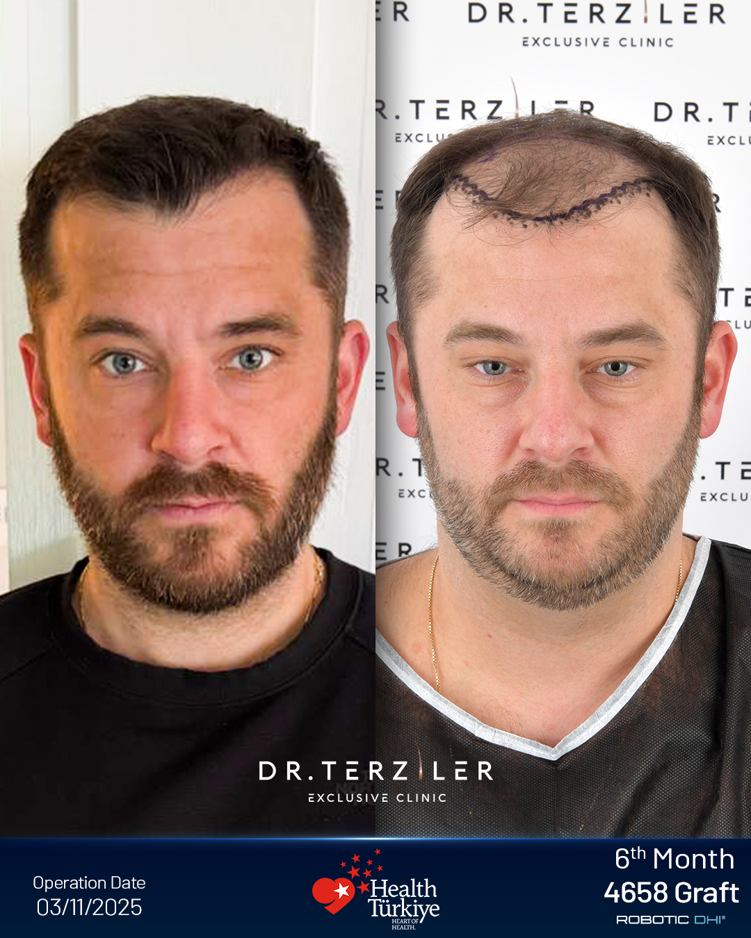 Hair transplant Turkey before and after result,Corey J. from the USA, Robotic DHI, 5,355 grafts, Norwood 5 case study at Dr. Terziler Exclusive Clinic