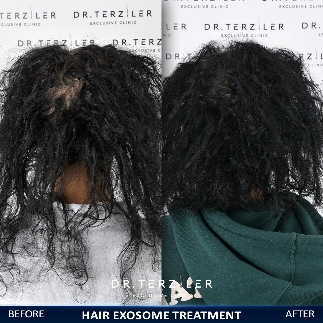 hair treatments for black women results with hair exosome treatment by Dr. Terziler Exclusive Clinic